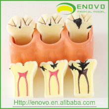 EN-M1 4Times Enlarge Caries Disassembling Model